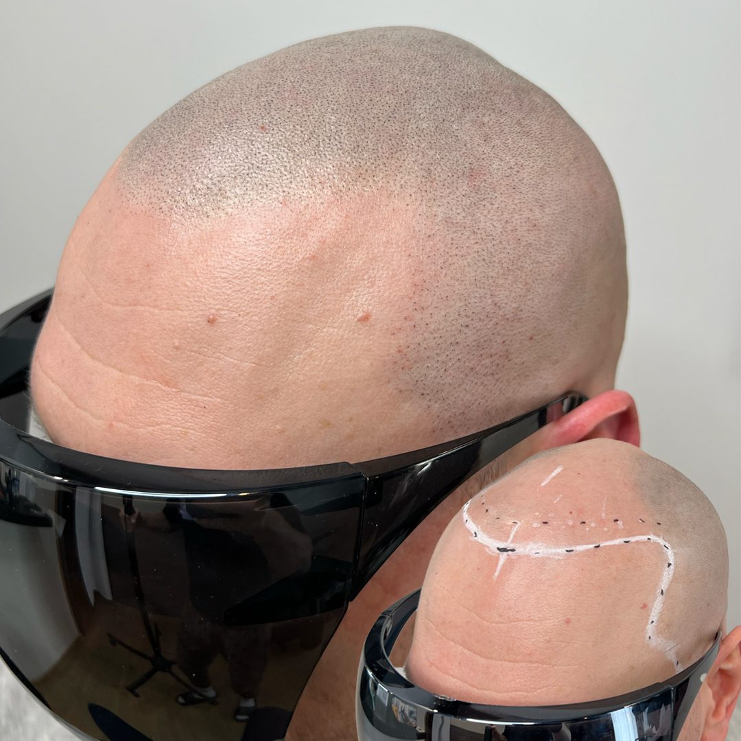 SMP ennen ja jälkeen – luonnollinen Scalp Micropigmentation -tulos suomalaiselle asiakkaalle