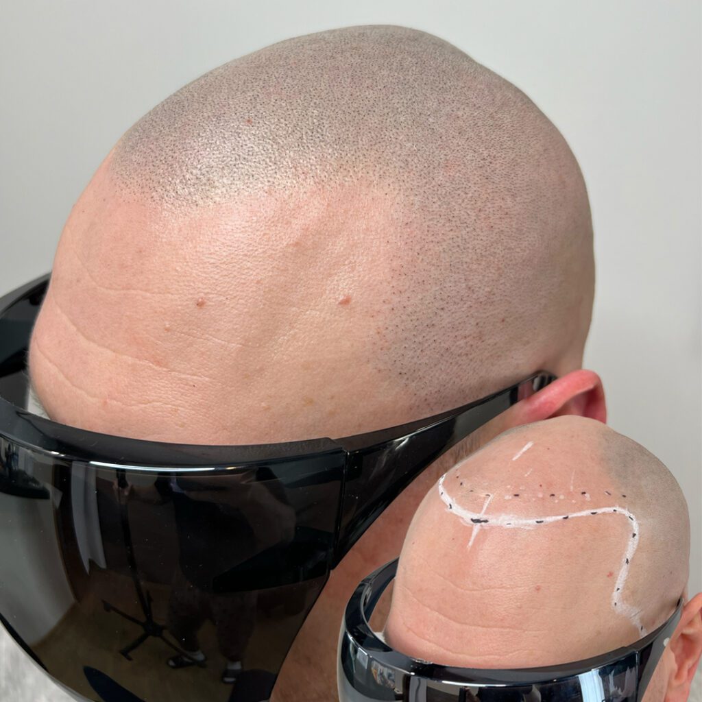 Luonnollinen SMP-tulos – Scalp Micropigmentation Helsinki