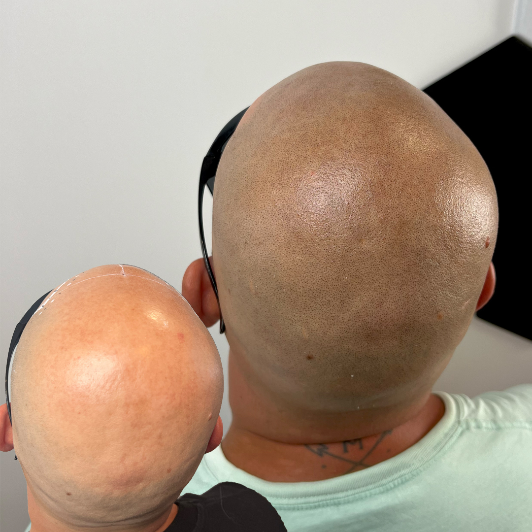 shaved head 4