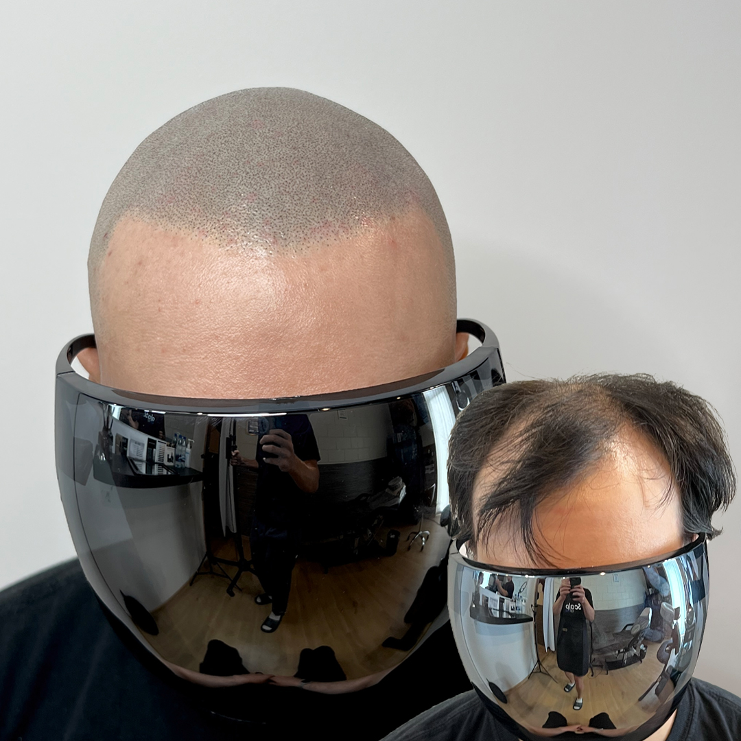 shaved head 14