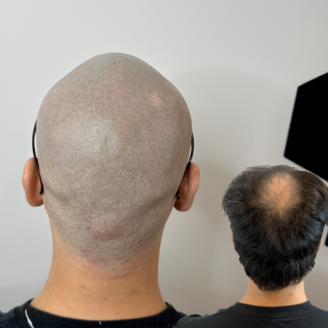 shaved head 14