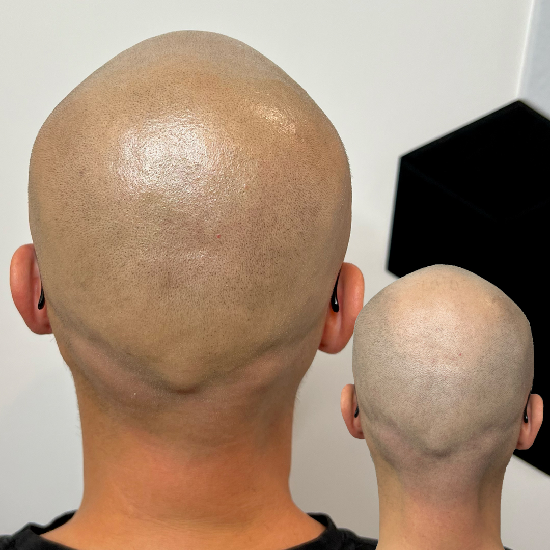 shaved head 1