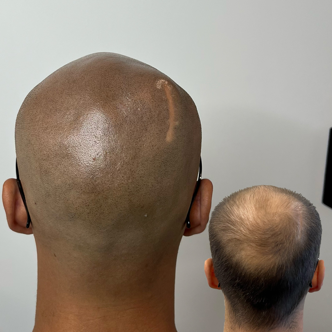 shaved head 3