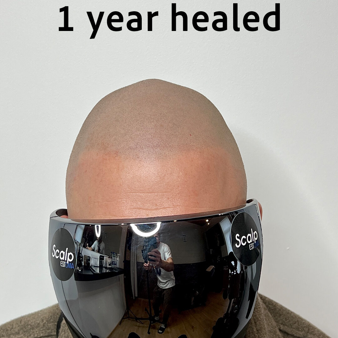 1 aasta paranenud SMP