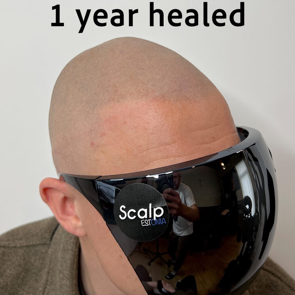 1 aasta paranenud SMP