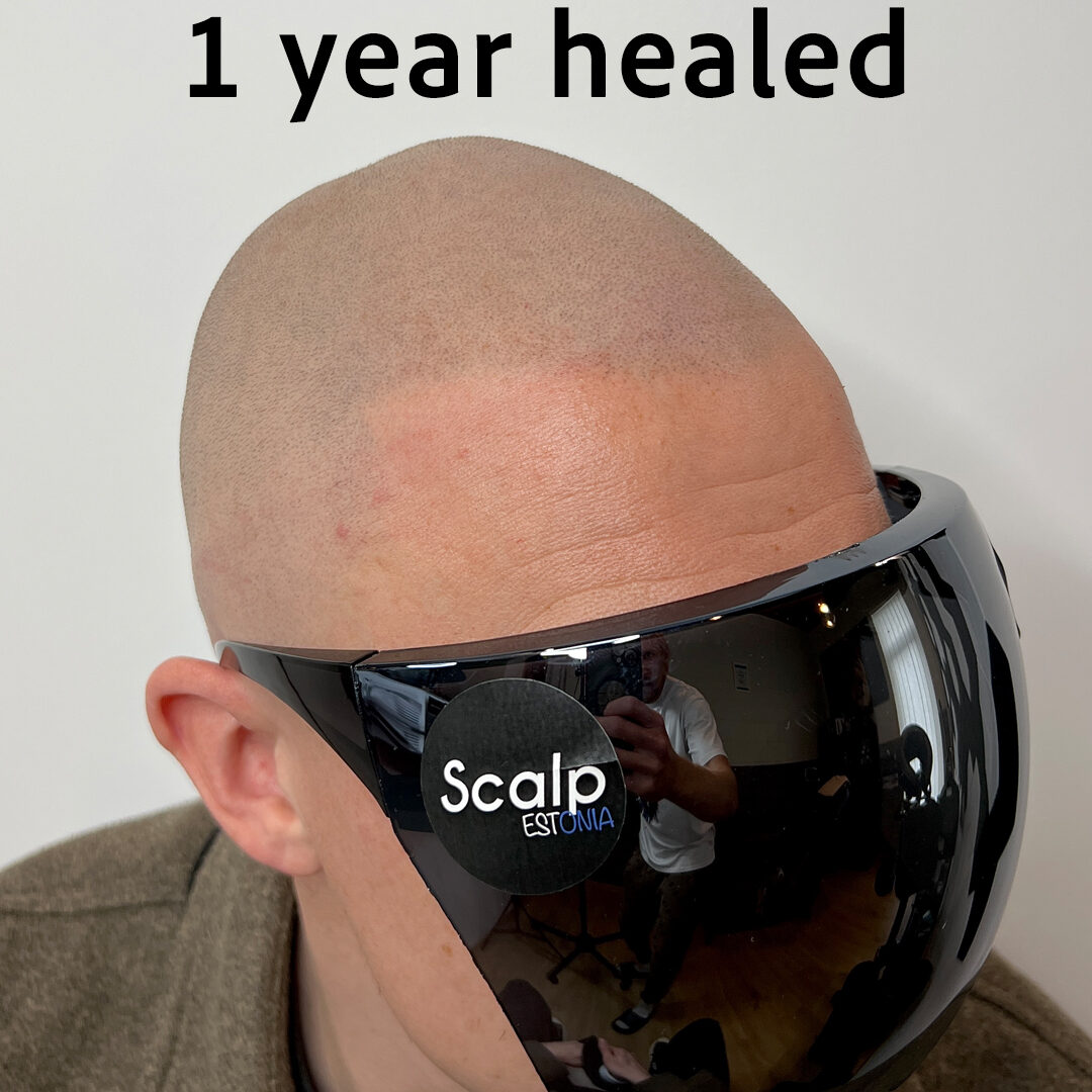 1 aasta paranenud SMP