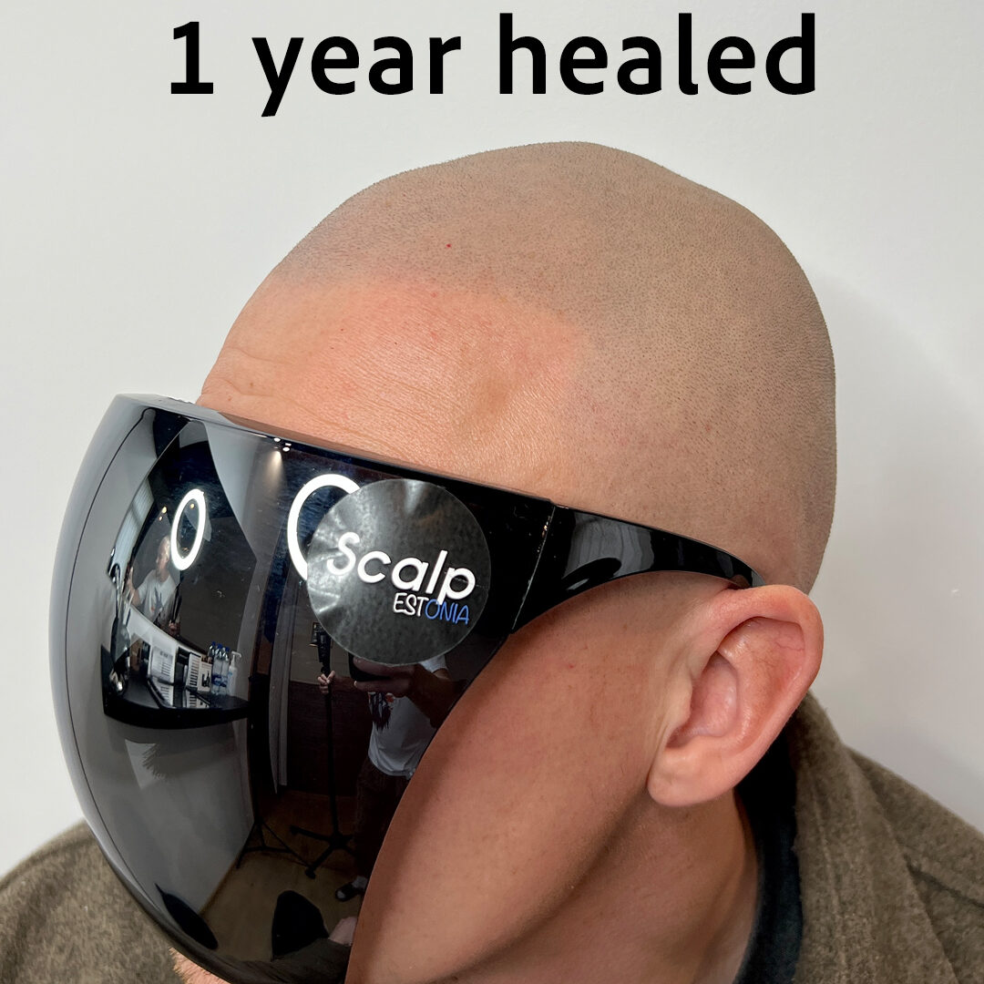 1 aasta paranenud SMP