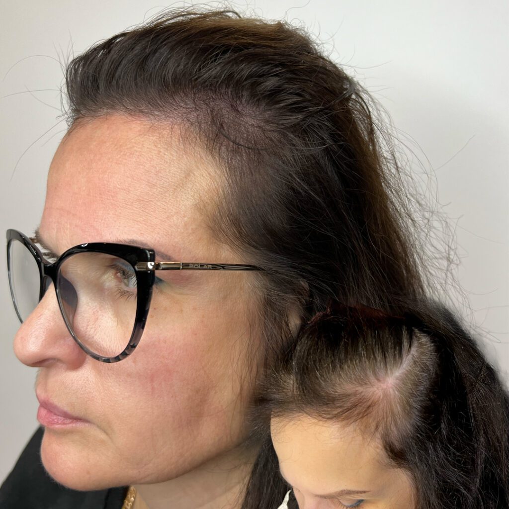 Scalp Micropigmentation (SMP) tulemus kiilanemise korral külgvaates