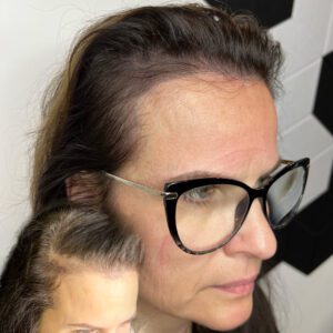 Scalp Micropigmentation (SMP) tulemus naiste juuste hõrenemise korral