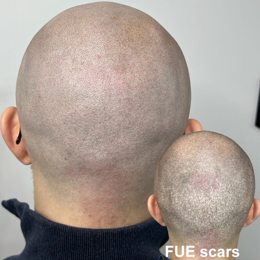 Scalp Micropigmentation (SMP) juuste siirdamise armide peitmiseks
