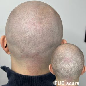 Scalp Micropigmentation (SMP) juuste siirdamise armide peitmiseks