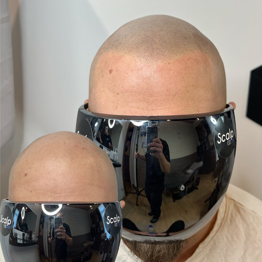 Scalp Micropigmentation (SMP) tulemus kiilanemise korral eestvaates