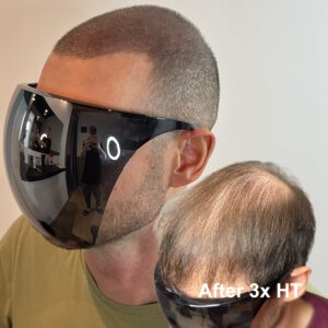 Scalp Micropigmentation (SMP) juuste siirdamise tulemuse visuaalseks tihendamiseks