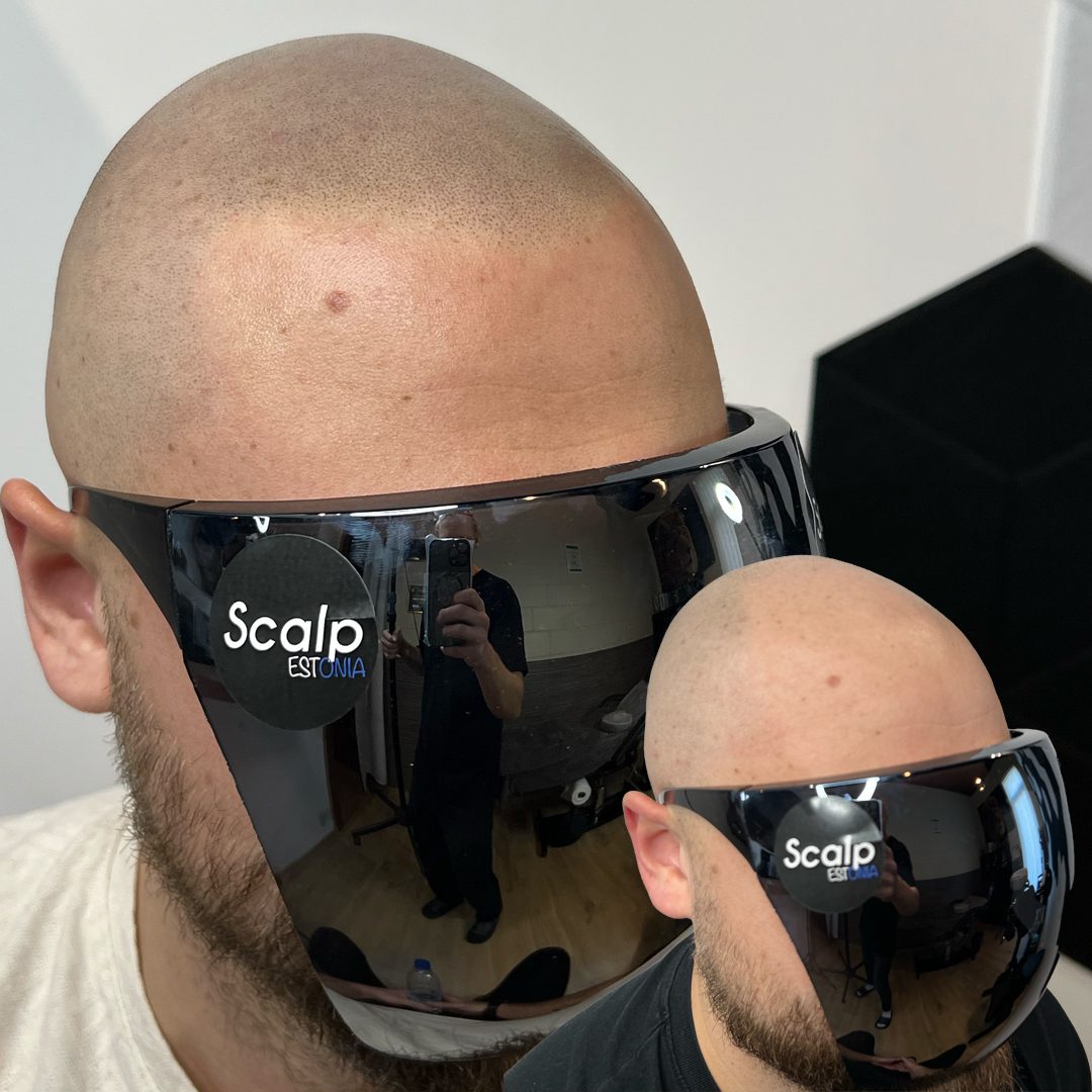 Scalp Micropigmentation (SMP) tulemus kiilanemise korral külgvaates