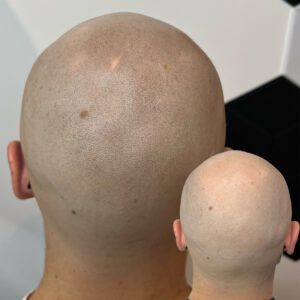 Scalp Micropigmentation (SMP) tulemus kiilanemise korral tagantvaates