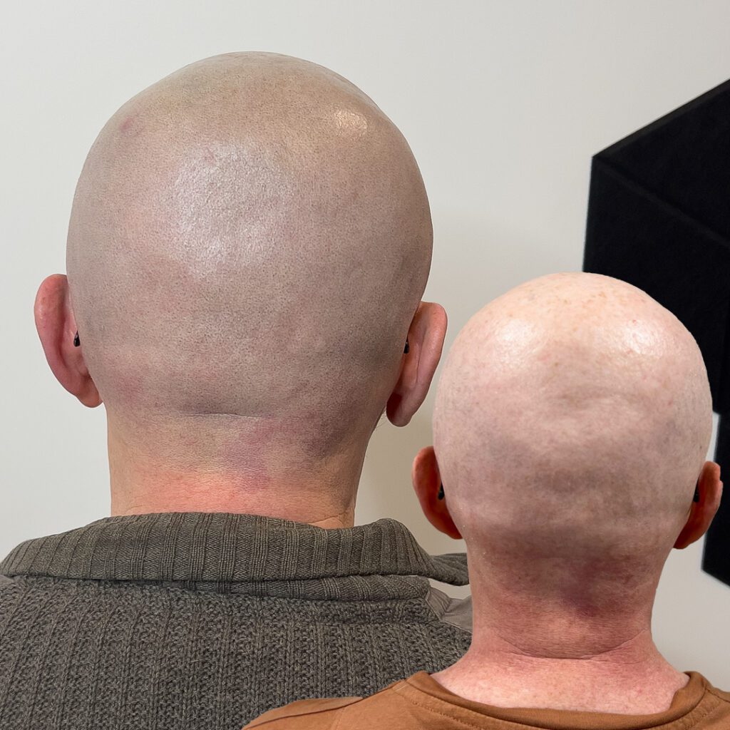 Alopeetsia peale peanaha mikropigmenteerimist